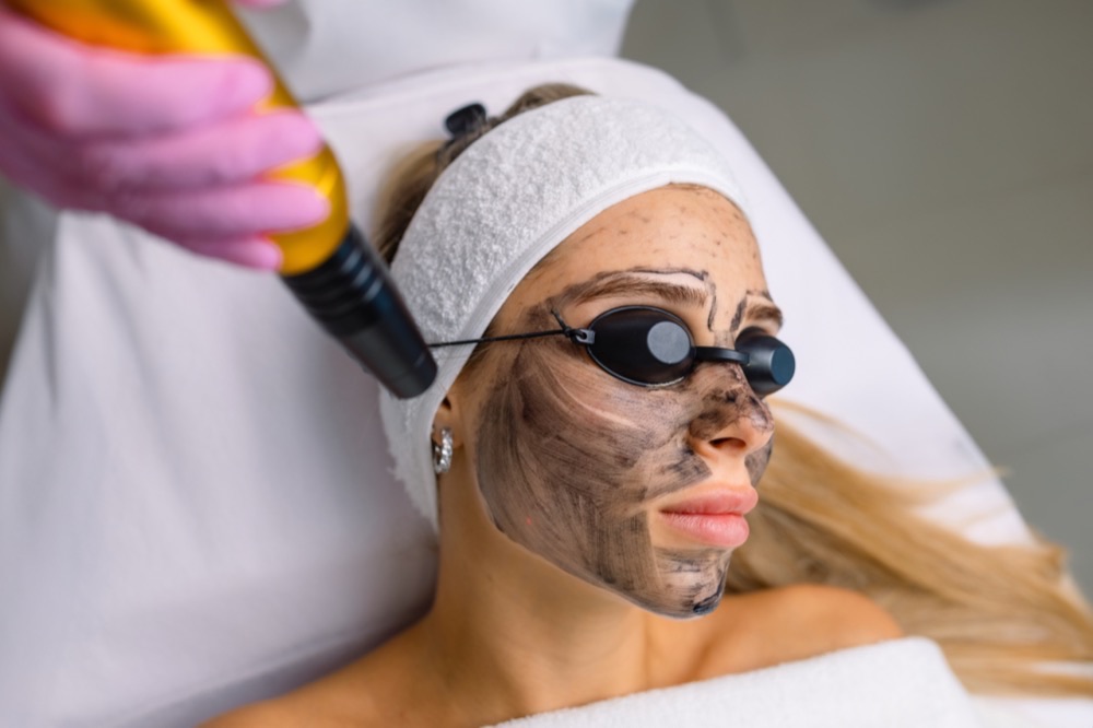 Lazerinis veido odos atjauninimas su anglimi (Carbon Laser Peel)